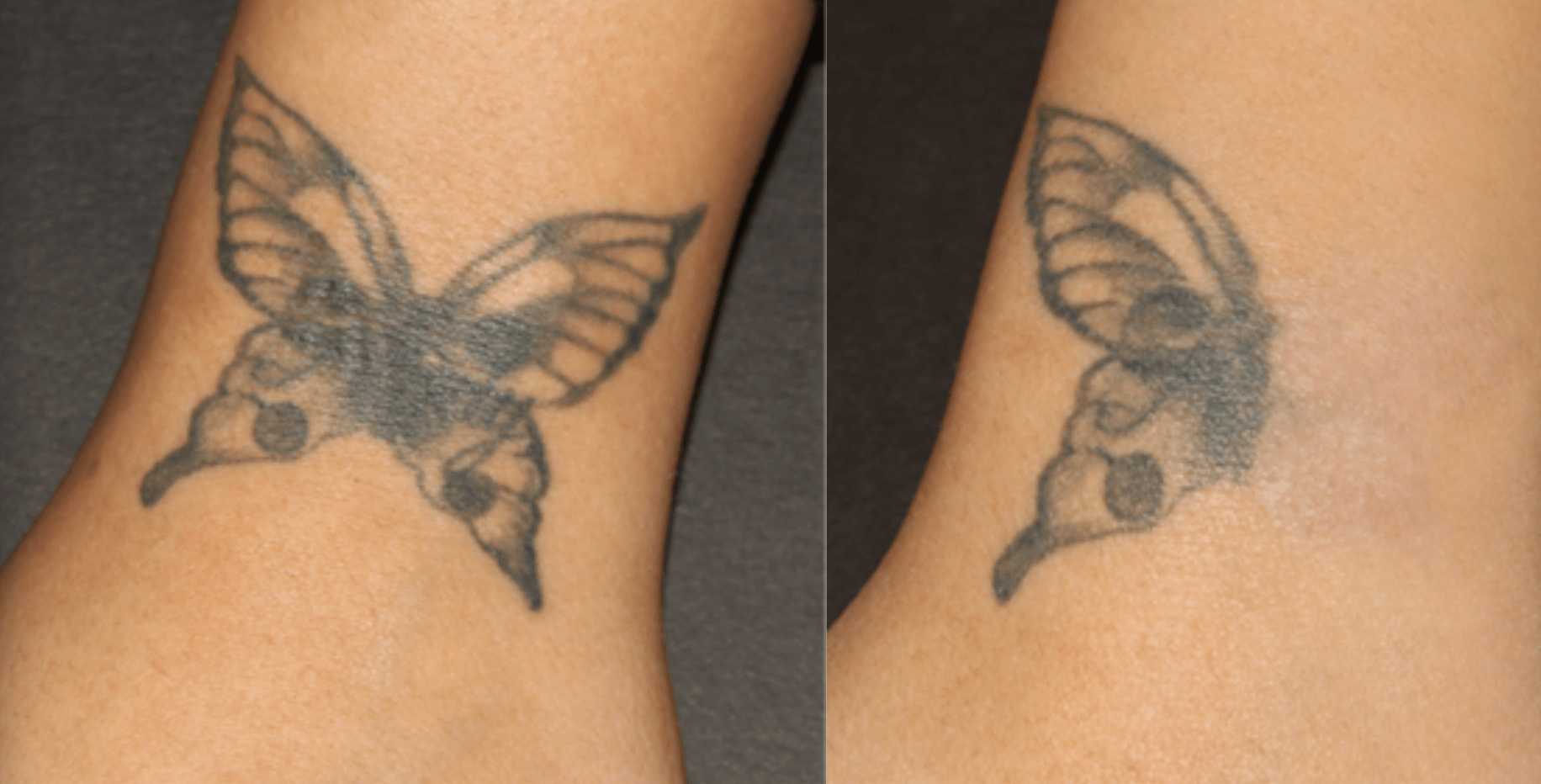 tatto-removal